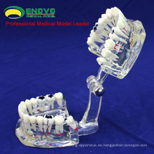 DENTAL09 (12568) Modelo oral de enfermedad humana de tamaño transparente adulto